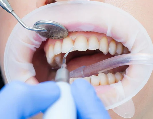 Чистка зубов